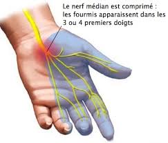 Anatomie du syndrome du canal carpien lié aux risques des gestes répétitifs au travail.